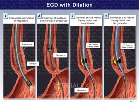com Upper Gastrointestinal <b>Endoscopy</b> 43239 - <b>EGD</b> with biopsy Multiple lesions Lesion (s. . Egd with savary dilation cpt code